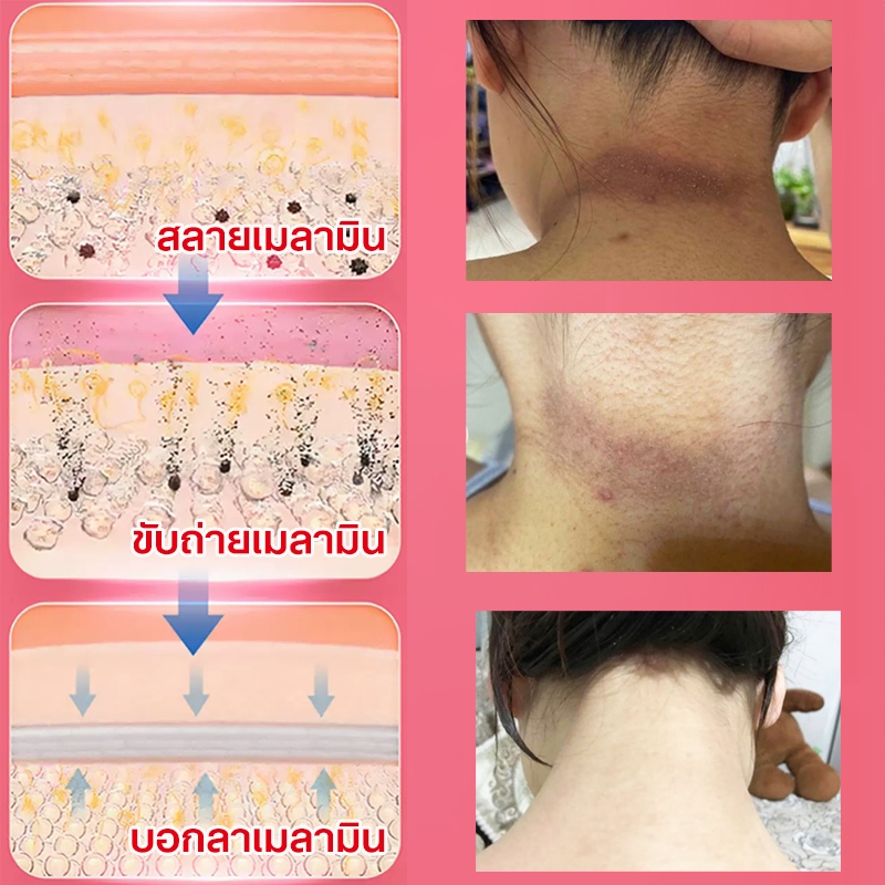 ครีมทาขาหนีบขาว ครีมทารักแร้ขาว ครีมไวท์เทนนิ่ง 100g ลบเมลานิน ใช้ทาข้อศอก ข้อเข่า คอ ขา บิกินี่ หน้า รักแร้ ฯลฯได้ - รูปที่ 7