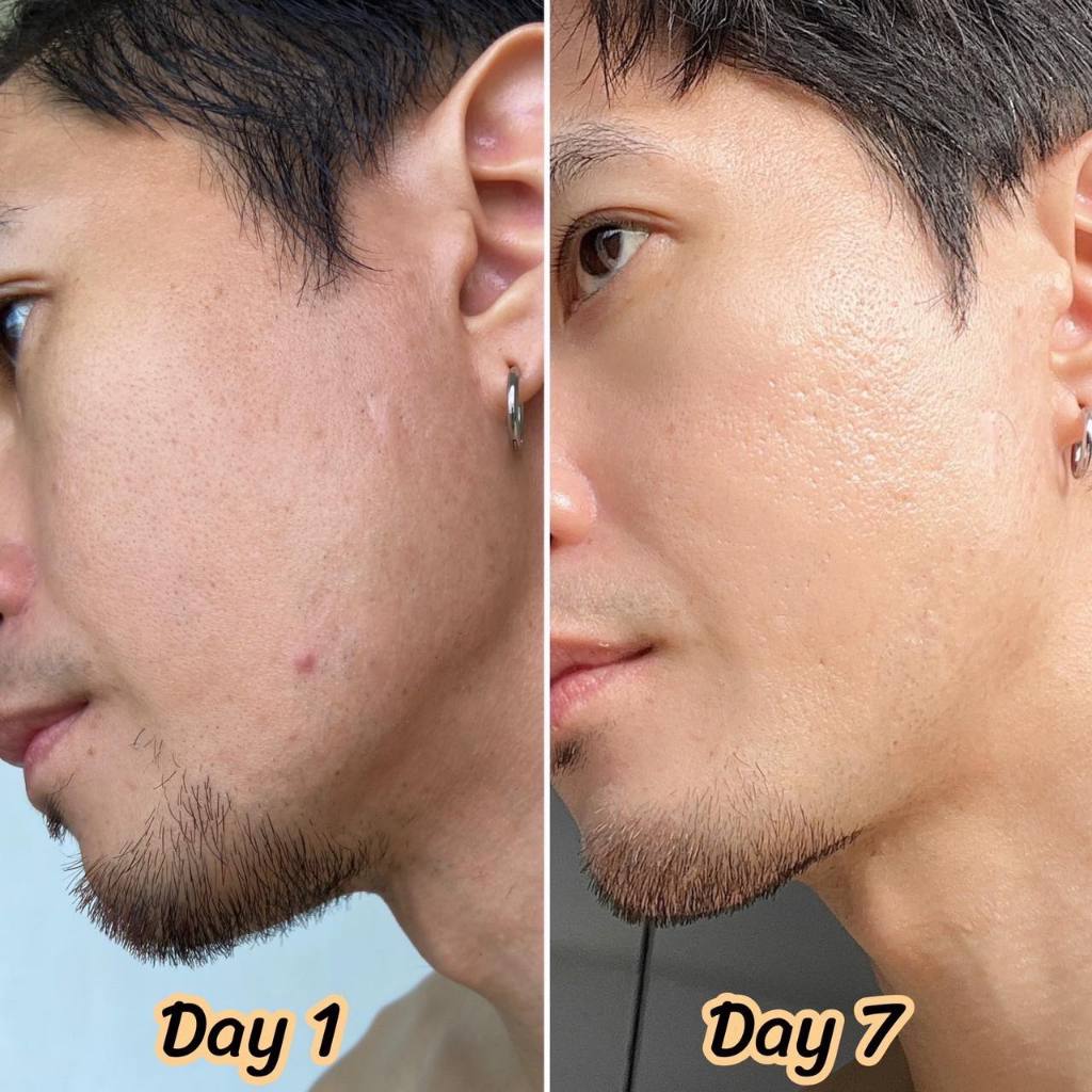 (ของแท้+พร้อมส่ง)🩸Dragon's Blood Acne Scar ดราก้อนบลัด สการ์เจล แบบซอง บำรุงผิวหน้า ลดรอยสิว ขนาด 7g. - รูปที่ 7