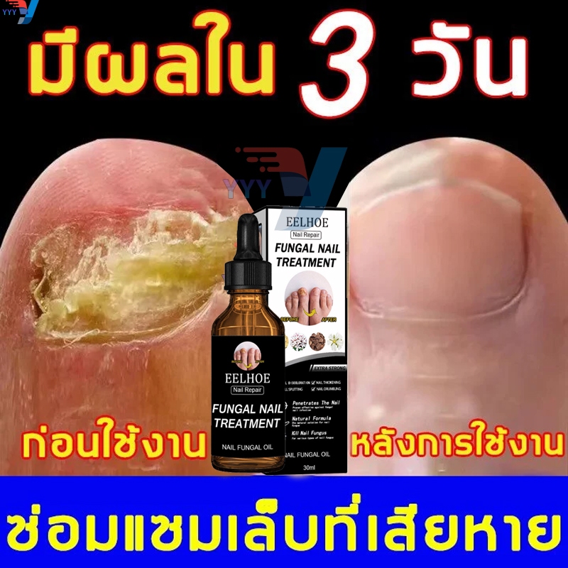 เห็นผลภายใน7วัน เซรั่มบำรุงเล็บ ครีมซ่อมเล็บ ช่วยให้เล็บกลับมาแข็งแรง ครีมบำรุงเล็บ ยาเชื้อราเล็บ เซรั่มรักษาเล็บ 30ml50