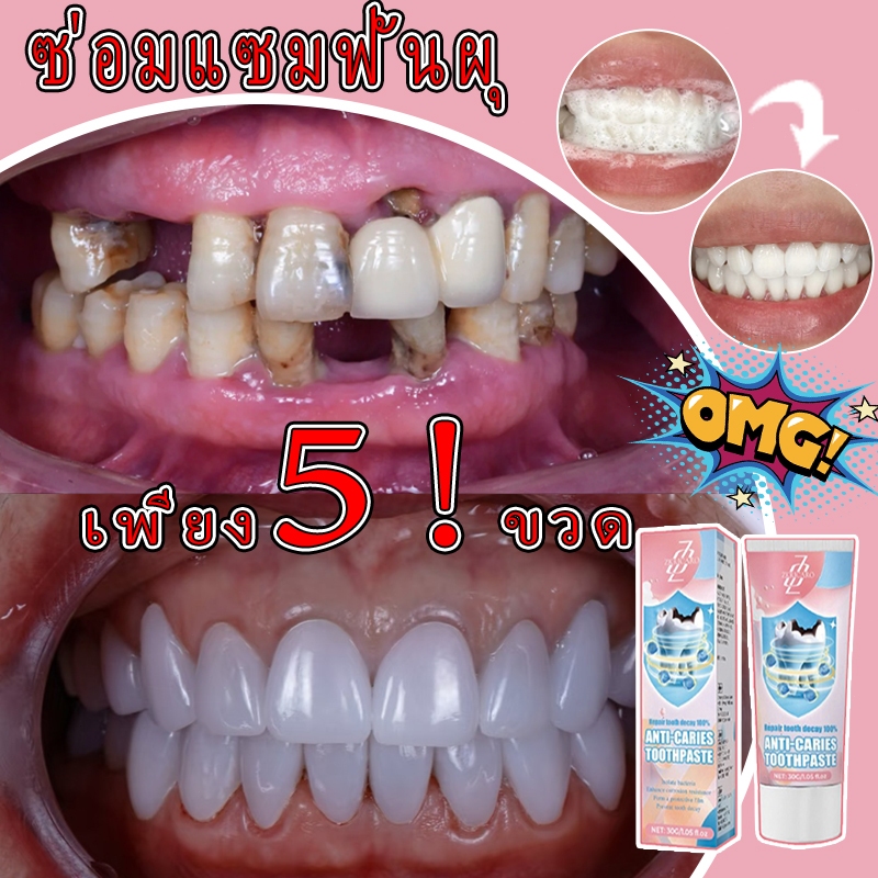 จัดส่งทันที ช่วยให้ฟันขาวขึ้นและป้องกันฟันผุ สูตรฟลูออไรด์ช่วยลดคราบหินปูนและขจัดคราบฟันเหลือง