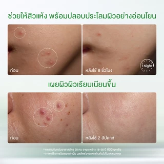Glad2Glow Acne Drying Lotion Serum ๘ ชั่วโมง เซรั่มลดสิว เจลแต้มสิว ลดรอยสิว ลดรอยแดง ลดการอักเสบ ที่ช่วยลดรูขุมขนและสิว