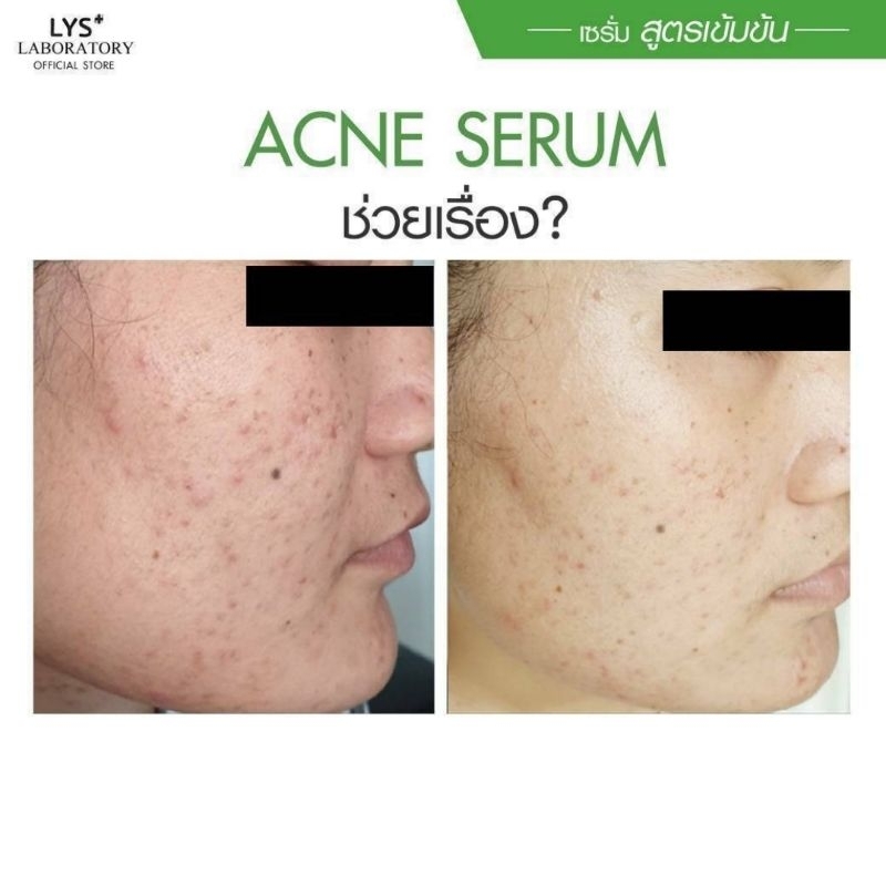 [🔥ส่งฟรี]LYS Acne Serum งานวิจัยรับรอง สิวผด สิวฮอร์โมน 30 ml