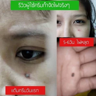 ครีมไฝจีจี้ ขี้แมลงวัน ติ่งเนื้อ หูด ตาปลา แก้ปัญหา กระ สิวหิน ไฝ หูด จี้ไฝ แต้มตาปลา