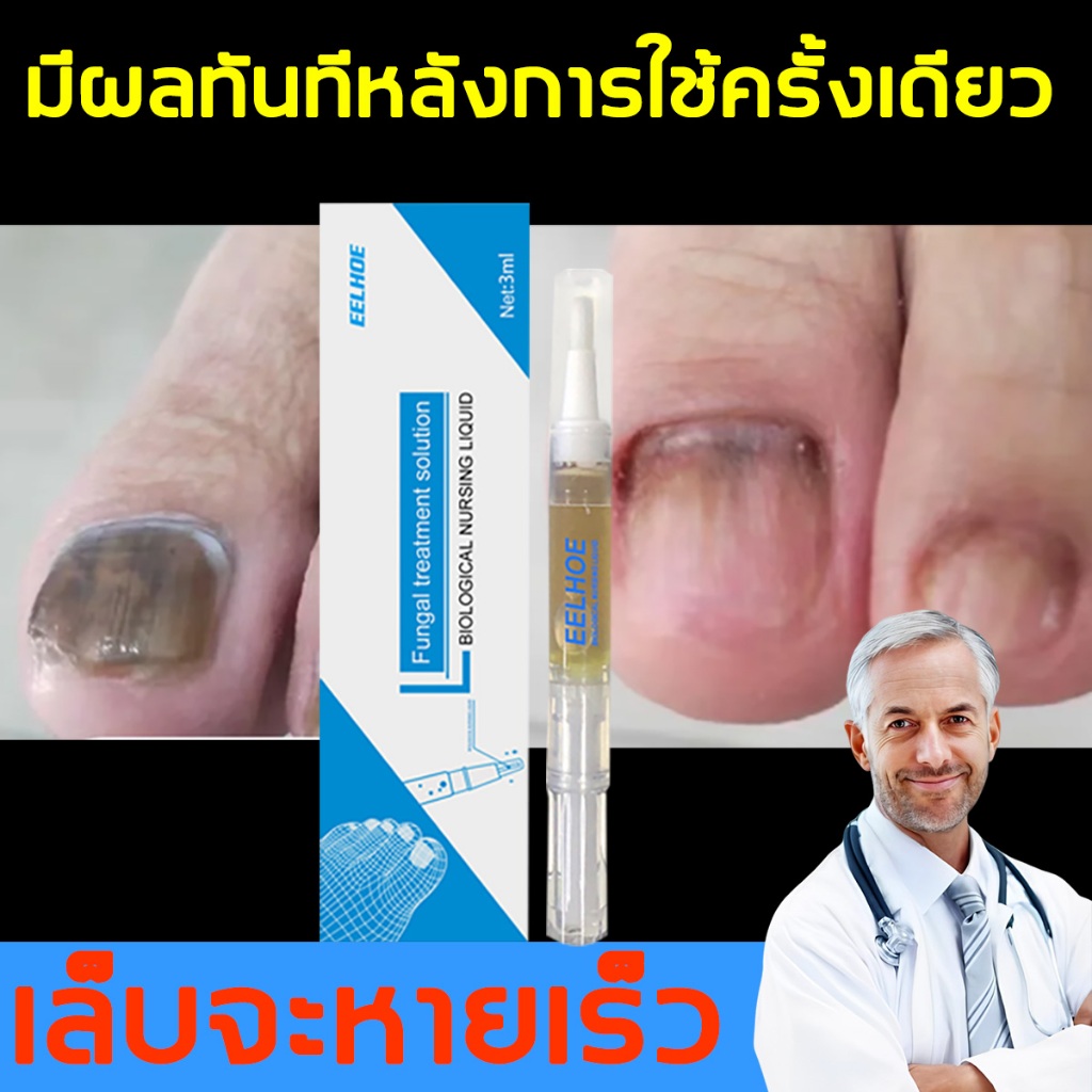 【7วันเจอผล】 เซรั่มบำรุงเล็บ แก้ปัญหาเล็บหนาเรื้อรังจากเชื้อรา ไม่ทำร้ายเล็บ เล็บขบ เชื้อรา Nail Repair Essence Serum