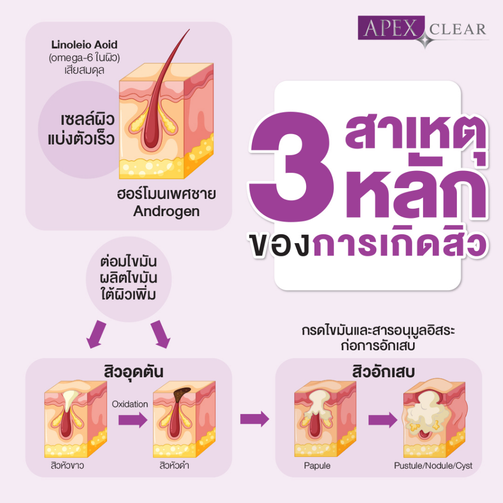 [E-Voucher] APEX Acne Clear โปรแกรมเคลียร์วงจร สิว รักษาลดรอยดำ แดง จากสิว ผลัดผิว ฉายแสงฆ่าเชื้อสิว