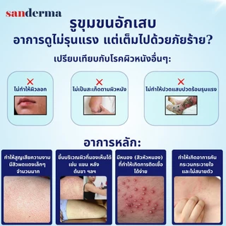 [Combo 2] Sanderma ครีมแก้คัน และ เซรั่ม แซนเดอร์ม่า ลดผื่นคัน เชื้อรา ผิวแพ้ง่าย ลดรอยแดง