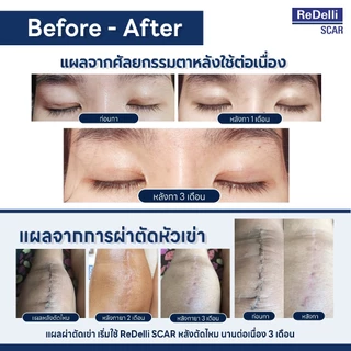 ReDelli SCAR ซิลิโคนเจล ขนาด 9 / 18 กรัม ดูแลป้องกันแผลเป็น ลดแดง นูน คัน นุ่ม จาง และรอยแผลจางลง