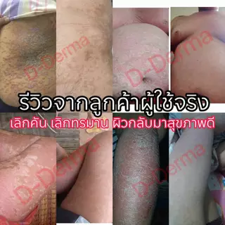 (เจ้าของ) D-Derma สบู่ว่านและครีม การคัน ผดผื่น สะเก็ดเงิน ผิวหนังอักเสบ กลากเกลื้อน เชื้อรา