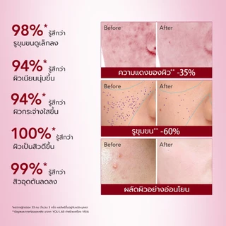 YOU 6% Acid Renewal Peeling Serum 20ml เซรั่มผลัดเซลล์ผิวเข้มข้น 6% AHA BHA กระชับรูขุมขน ลดสิว ผิวกระจ่างใส เซรั่มแดง