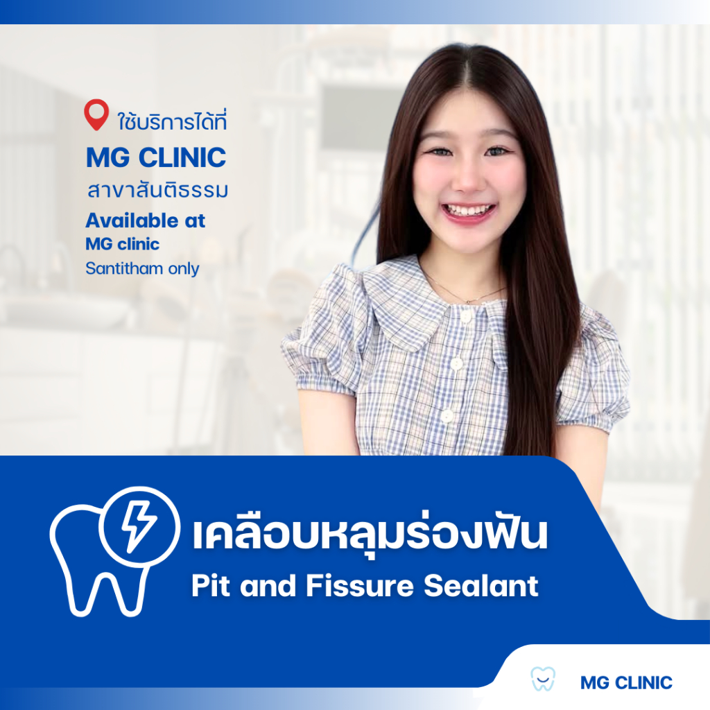 โปรแกรมเคลือบหลุ่มร่องฟัน (Pit and Fissure Sealant) - MG Dental Clinic