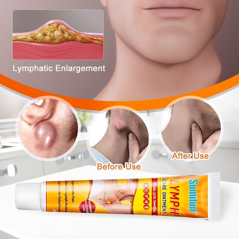 Sumifun Lymph แท้100% ครีมลดอาการอักเสบบริเวณต่อมน้ำเหลือง บริเวณคอ และรักแร้