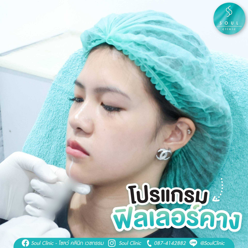 Soul Clinic โปรแกรมฟิลเลอร์คางสวย 1CC