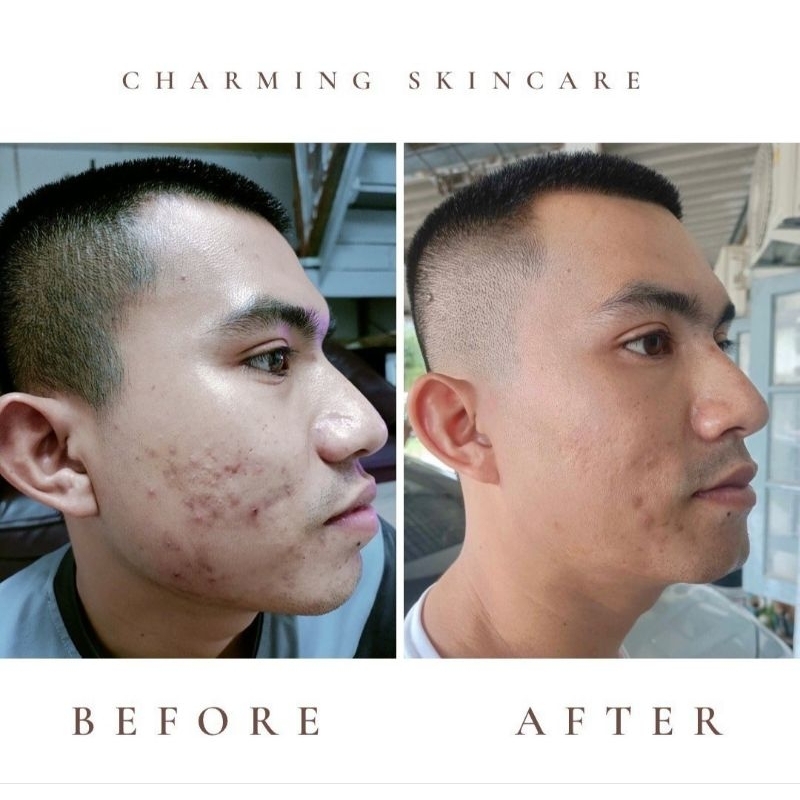 ครีมชาร์มมิ่ง สกิน charming skin เซตสุดคุ้ม ขายดี(ครีมเล็ก+เซรั่ม +กันแดด) - รูปที่ 7