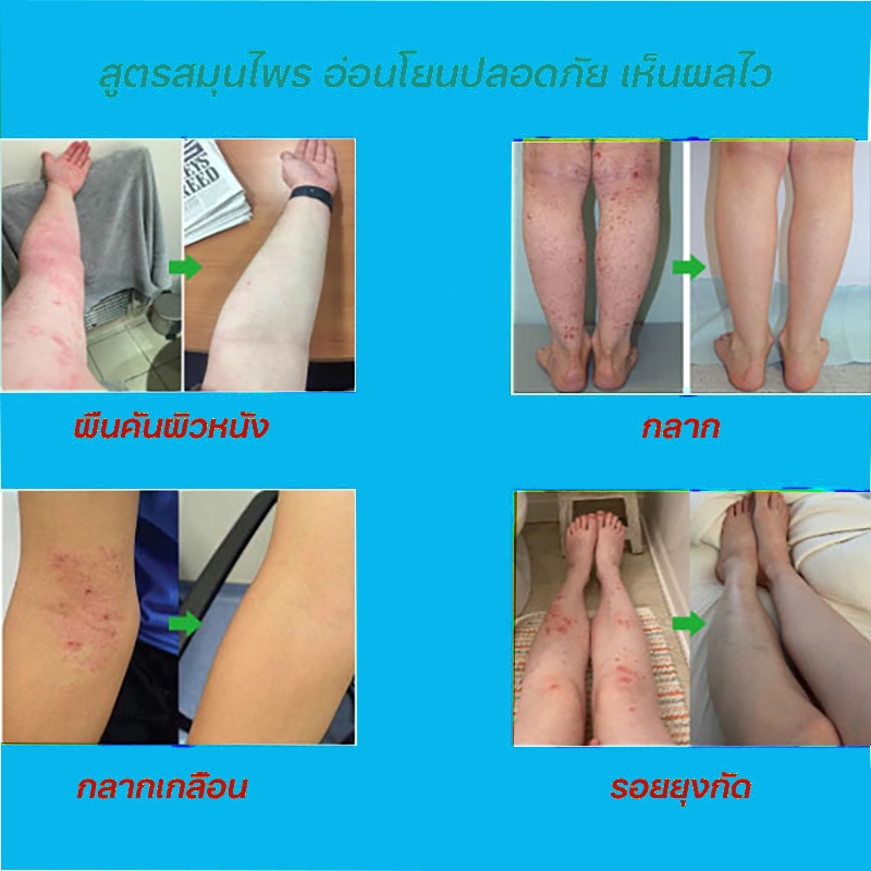 （ซื้อ 2แถม1)ครีมดูแลผิว มีผลในการป้องกันการเจริญเติบโตของเชื้อรา ใช้ทาได้ทุกตำแหน่งของร่างกายไม่ระคายเคืองปราศจากสารเคมี - รูปที่ 4