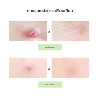 Shimanto แผ่นแปะสิว แผ่นดูดสิว 9ดวง ขนาด14mm มีสารบำรุง ลดการอักเสบ ลดรอยแดง ดูดสิวยุบไวทันใจ