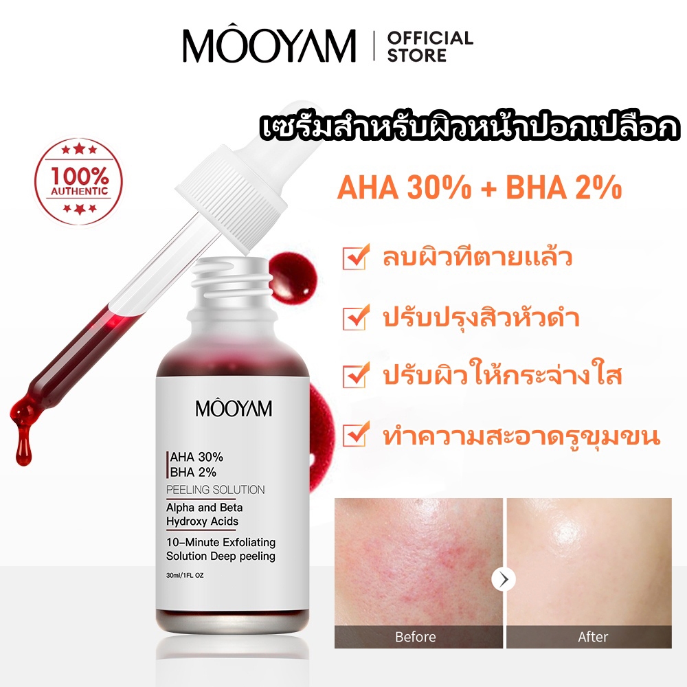 MOOYAM AHA 30%+BHA 2% เซรั่ม กรดผลไม้ Salicylic กรดขัดผิวรักษาสิวเอสเซนส์ 30 มล ผลิตภัณฑ์ดูแลผิวหน้า