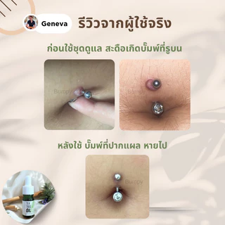 ทีทรีออยล์ Tea tree oil (ยี่ห้อบั๊มพ์ปี้) ขนาด 5 มล. ทาแผลเจาะใหม่ แผลบั๊มพ์ หนองเรื้อรัง อักเสบบวม ปวด หลังเจาะ แต้มสิว