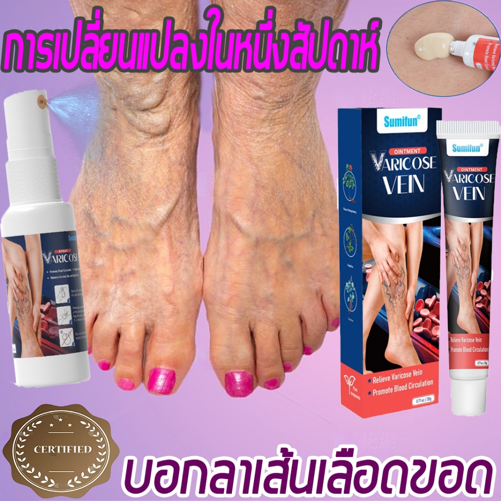 เส้นเลือดขอด ครีมทาเส้นเลือดขอด รักษาขาให้สวย ครีม บรรเทาอาการปวด แท้100 เส้นเลือดฝอยแตก Varicose ลดปวด อักเสบ