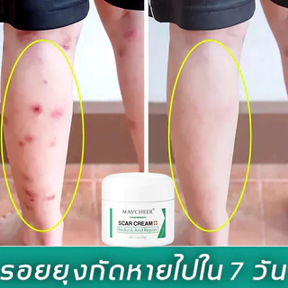 【มีสินค้าพร้อมจัดส่ง】ALIVER 50ml ครีมลดรอยแผลเป็น แผลเป็น ลดเลือนแผลผ่าตัดการคลอด แผลผ่าตัด แผลเป็นใหม่และแผลเป็นเก่า