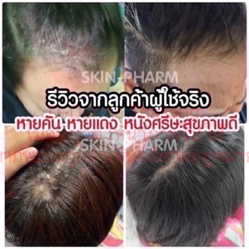 (บริษัท) เซ็ทแชมพูและเซรั่มดูแลหนังศีรษะ รังแค หนังศีรษะลอก ศีรษะอักเสบ เซ็บเดิร์ม ต่อมไขมันอักเสบ