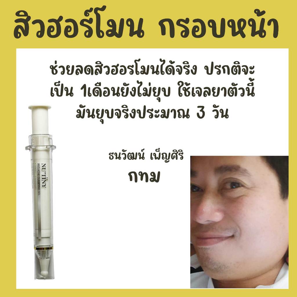 เป็นสิวที่คาง ซ้ำๆpantip สิวอักเสบ ที่คาง เรื้อรัง สิวที่คาง มดลูก สิวขึ้นคาง ไม่มี หัว Pantip สิวหั