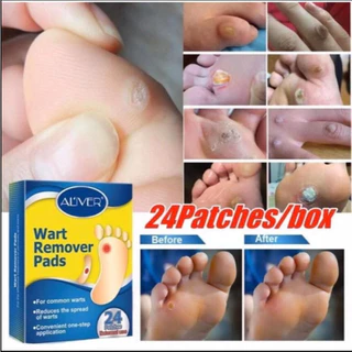พร้อมส่งจากไทย แผ่นรองเท้า สำหรับหนังเท้าด้าน แผ่นแปะตาปลา สูตรพืช ใช้ง่าย [ ของแท้] เอลิเวอร์ 24แผ่น/กล่อง
