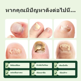 Kreain Nature น้ำยาซ่อมแซมเล็บขิงและทีทรีออยล์ รักษาเชื้อราที่เล็บใน 7 วัน ฆ่าเชื้อแบคทีเรีย-ป้องกันการลุกลาม