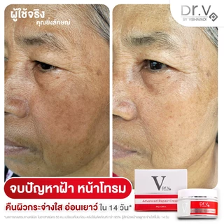 ครีมลดฝ้ากระและจุดด่างดำ Dr. V Advanced repair cream