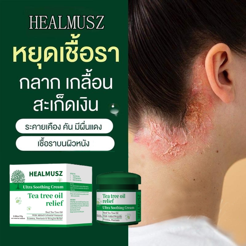 แก้ผื่นคัน ผิวหนังอักเสบ กลาก สะเก็ดเงิน เกลื้อน รักษาอาการคันเท้าแตก แก้เชื้อรา ครีมทาโรคผิวหนัง รักษาโรคผิวหนัง ครีมส