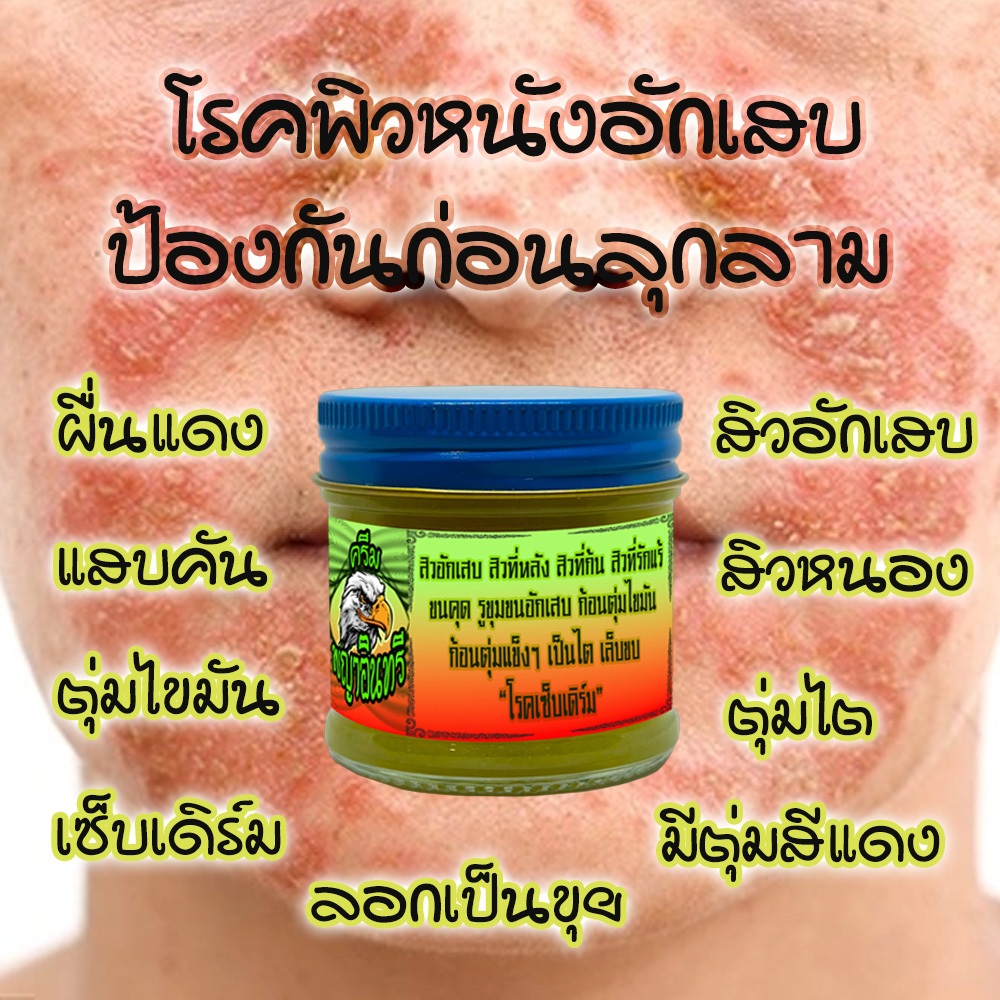 สำหรับคนเป็นเซ็บเดิร์ม สิวอักกเสบ ตุ่มน้ำใส จากธรรมชาติ เห็นผลไว กำจัดแบบขุดรากถอนโคน