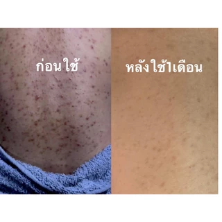 เซทรักษาสิวหลัง หน้า อก ไหล่ SET 6ชิ้นสุดคุ้ม สบู่+สเปรย์+เซรั่มใบชาสูตรแพทย์แผนไทย+ตาข่ายตีฟอง+ใยบวบ+แปรงขัดหลัง