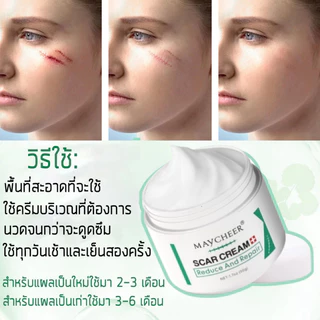 【มีสินค้าพร้อมจัดส่ง】ALIVER 50ml ครีมลดรอยแผลเป็น แผลเป็น ลดเลือนแผลผ่าตัดการคลอด แผลผ่าตัด แผลเป็นใหม่และแผลเป็นเก่า