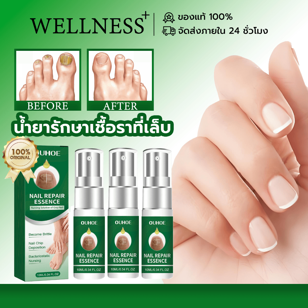 OUHOE น้ำยารักษาเชื้อราที่เล็บ เซรั่มฟื้นฟูเล็บ ยาทาเชื้อราเล็บ เชื้อราที่เล็บ ฆ่าเชื้อราที่เล็บ