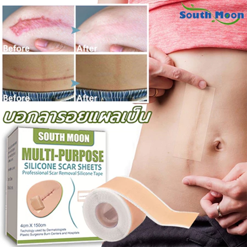 【🚚พร้อมส่ง】South Moon รักษารอยแผลเป็น แผ่นแปะแผลเป็น 4cm*150cm กําจัดรอยแผลเป็นจากแผลเ