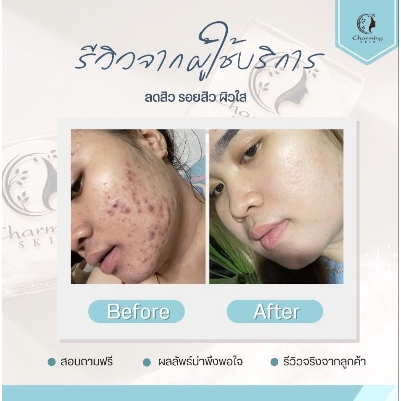 ครีมชาร์มมิ่ง สกิน charming skin เซตสุดคุ้ม ขายดี(ครีมเล็ก+เซรั่ม +กันแดด) - รูปที่ 4