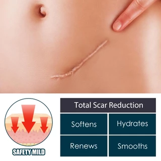 EELHOE ครีมทาแผลเป็น Gel For Scar เจล รอยแผลเป็น รอยสิว รอยดำ รอยแดง ทาแผลเป็นนูน ลบรอยแผลเปน Scar removal cream