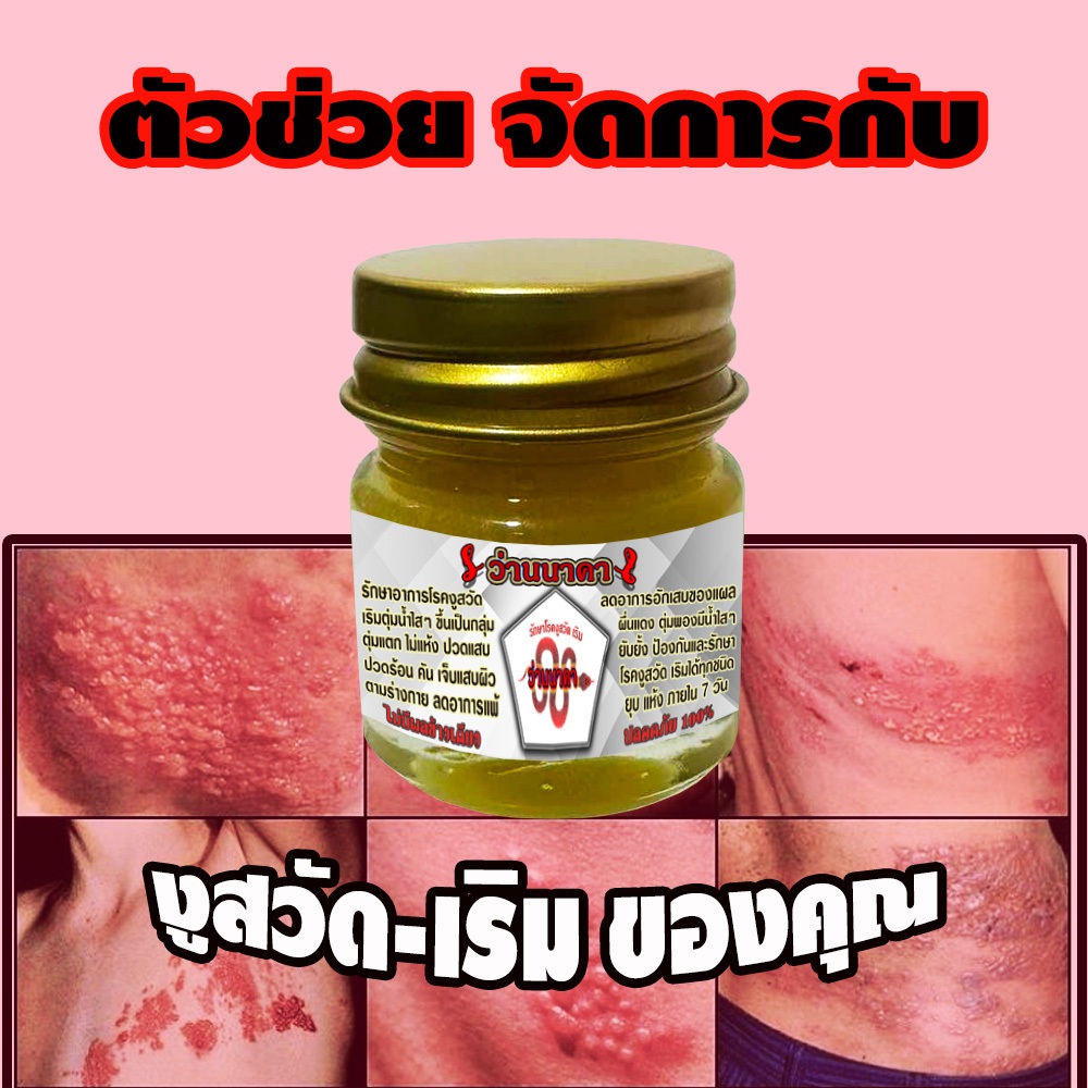 หยุดอาการงูสวัด เริม ไฟลามทุ่ง แสบคัน ผื่นกุหลาบ ขยุ้มตีนหมา ที่เป็นอยู่ด้วย ครีมเจลว่านนาคา