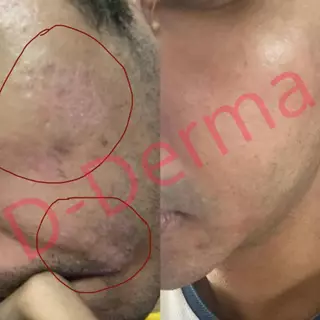 (ร้านเภสัช!!) เซรั่ม Anti-sebderm D-Derma เซ็บเดิร์ม ผิวแห้ง ลอก คัน ผิวหนังอักเสบ แพ้ง่าย ผดผื่น