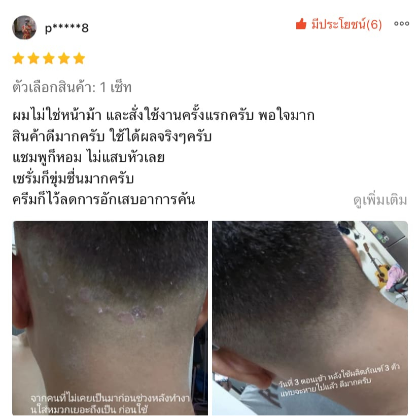 (บริษัท) เซ็ทแชมพูและเซรั่มดูแลหนังศีรษะ รังแค หนังศีรษะลอก ศีรษะอักเสบ เซ็บเดิร์ม ต่อมไขมันอักเสบ