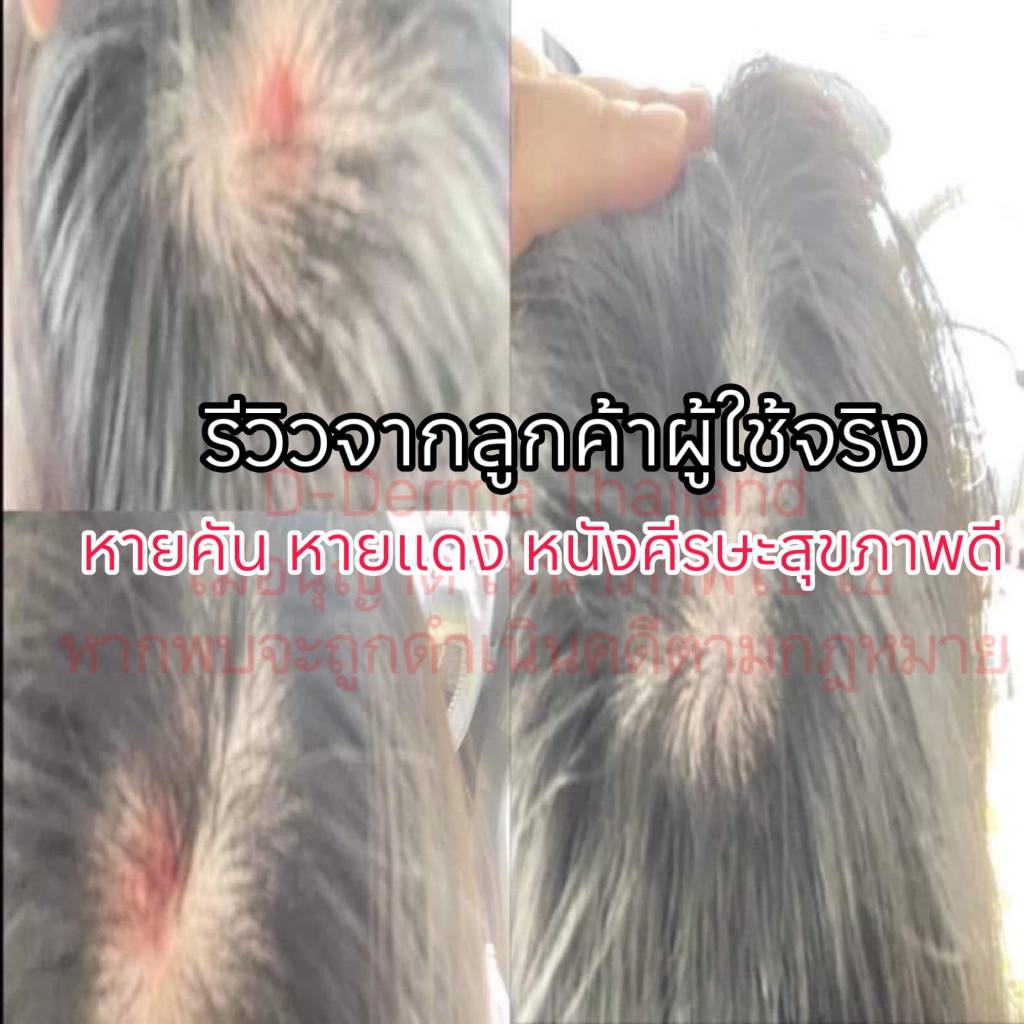 (บริษัท) เซ็ทแชมพูและเซรั่มดูแลหนังศีรษะ รังแค หนังศีรษะลอก ศีรษะอักเสบ เซ็บเดิร์ม ต่อมไขมันอักเสบ