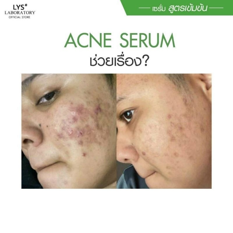 [🔥ส่งฟรี]LYS Acne Serum งานวิจัยรับรอง สิวผด สิวฮอร์โมน 30 ml