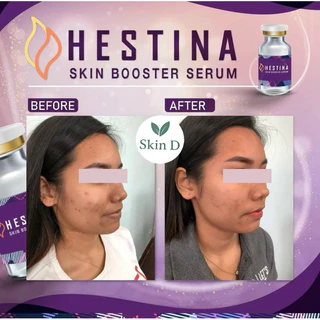 💜 Hestina หน้าใส ลดสิว ผิวแห้ง ขาดความชุ่มชื้น