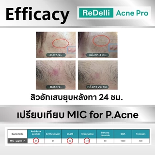 ReDelli Acne Pro รีเดลลี่ แอคเน่ โปร เซรั่มลดสิว สิว รักษาสิว Retinol + Peptide เรตินอล