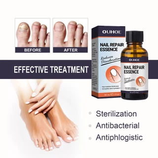 OUHOE เซรั่มเล็บ เชื้อราเล็บมือ Nail Care เซรั่มบำรุงเล็บ เซรั่มซ่อมแซมเล็บ และเล็บขบ บำรุงเล็บเสีย
