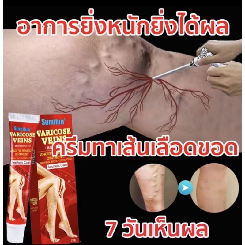 ￼แท้100% ครีม ทา เส้นเลือดขอด ของแทั เส้นเลือดฝอยแตก ครีมทาเส้นเลือดขอด เส้นเลือดขอด ส่งเสริมการไหลเวียนโลหิต