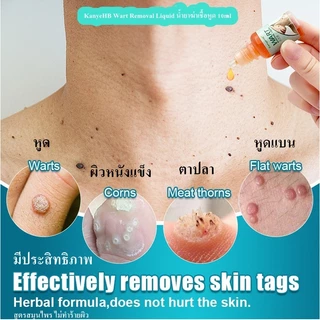 น้ำยาฆ่าเชื้อหูด 10ml KanyeHB's wart-removing liquid หูดหลุดได้อย่างรวดเร็ว