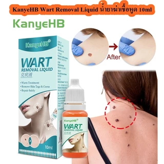 น้ำยาฆ่าเชื้อหูด 10ml KanyeHB's wart-removing liquid หูดหลุดได้อย่างรวดเร็ว