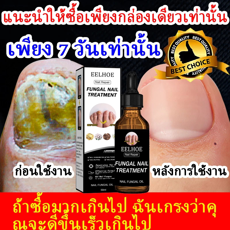 เห็นผลภายใน7วัน🔥เซรั่มบำรุงเล็บ ครีมซ่อมเล็บ ช่วยให้เล็บกลับมาแข็งแรง ครีมบำรุงเล็บ ยาเชื้อราเล็บ เซรั่มรักษาเล็บ 30ml50