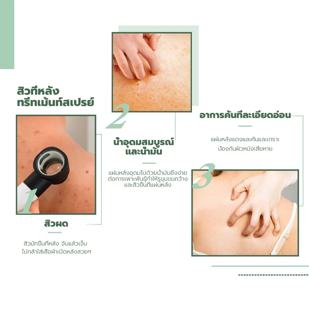 Jaysuing สิวที่หลัง แอคเน่ สเปรย์ฉีดแผ่นหลังและลำตัว ลดไรและสิวตามร่างกาย กำจัดสิวที่หลังและลำตัว ครีมแต้มสิว acne spray - รูปที่ 4