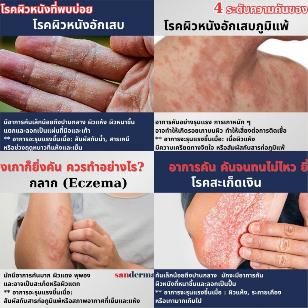 ครีมแก้คันผิวหนัง Sanderma Cream ครีมแก้คันผิวหนัง สำหรับผิวแห้ง ผิวลอก และระคายเคือง
